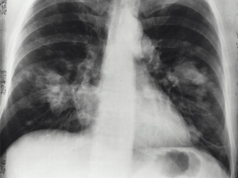 Chest xray. National Cancer Institute on Unsplash